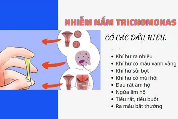 Nam-trichomonas-1