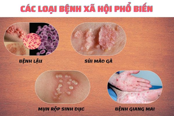 Xet-nghiem-benh-xa-hoi-2