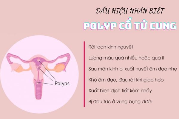 Polyp-co-tu-cung-1