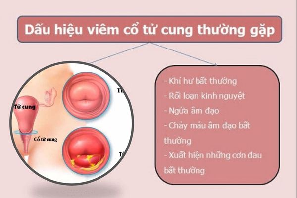 Trieu-chung-viem-co-tu-cung-2