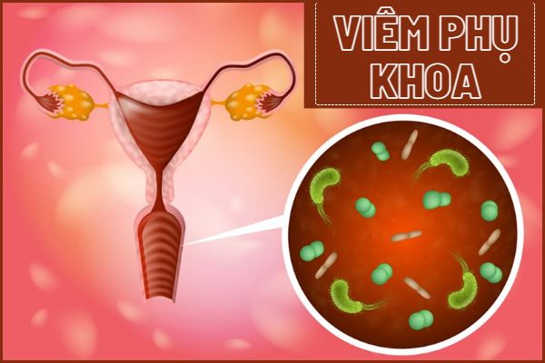 Cac-thong-tin-can-biet-ve-viem-phu-khoa-0