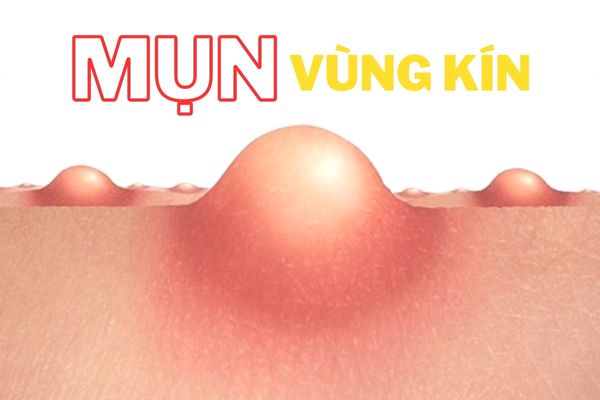 Mọc mụn ở mép vùng kín nữ giới có nguy hiểm không?