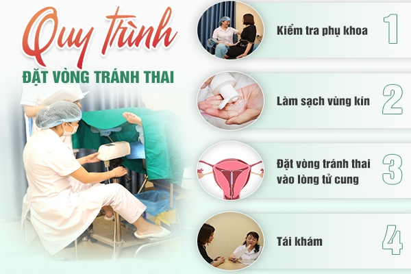 Quy trình đặt vòng tránh thai đúng chuẩn khoa học tại Hải Dương