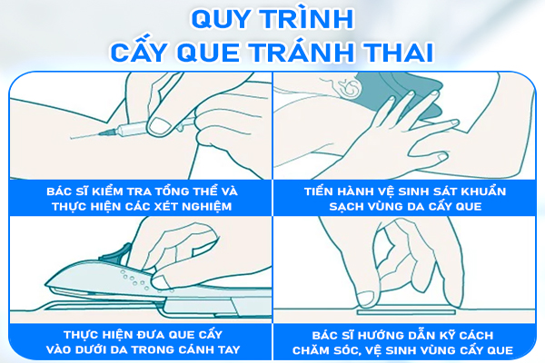 Quy trình cấy que tránh thai đạt chuẩn y tế tại Hải Dương