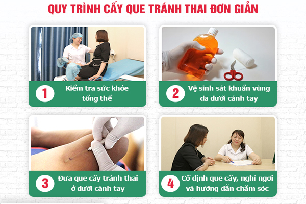 Quy trình cấy que chuẩn khoa học tại Phòng Khám Đa Khoa Hải Dương