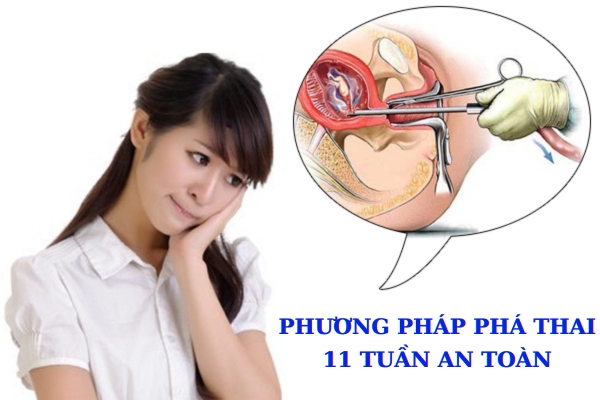 Thực hiện phá thai 11 tuần bằng biện pháp nào?