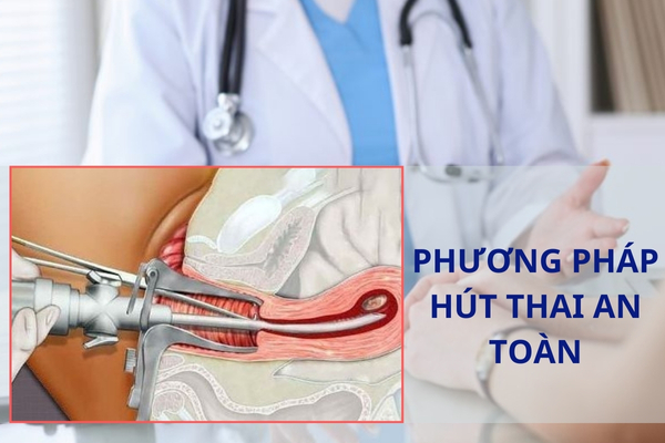 Phương pháp hút thai chân không an toàn tại Hải Dương