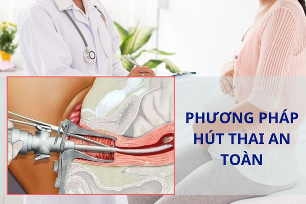 Phương pháp hút thai chân không – an toàn uy tín tại Hải Dương