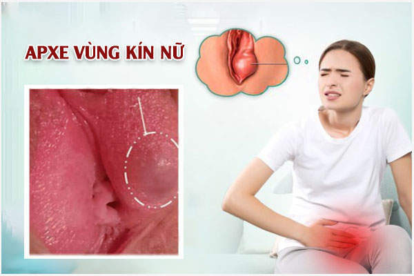 Áp xe vùng kín: Biểu hiện, Biến chứng và Cách khắc phục hiệu quả