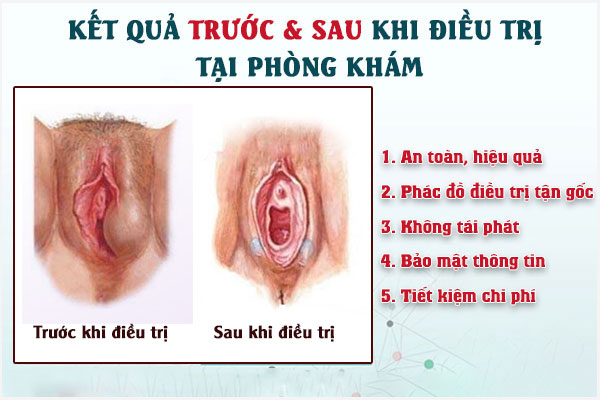 Ap-xe-vung-kin-nu-3