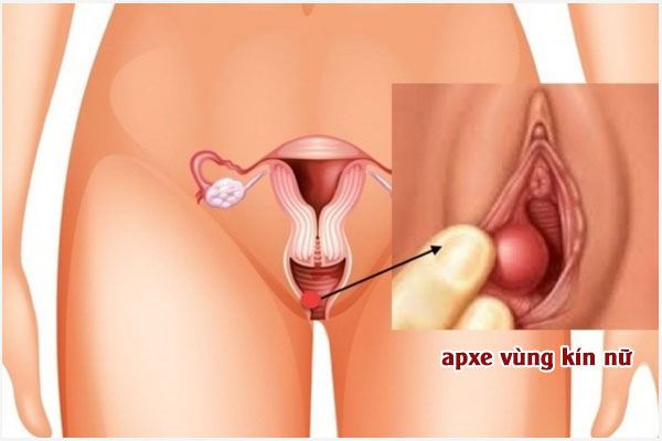 Ap-xe-vung-kin-nu