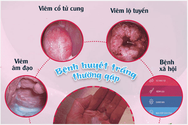 Benh-huyet-trang
