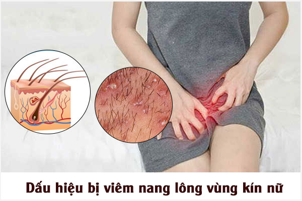 Dấu hiệu bị viêm nang lông vùng kín nữ và Cách khắc phục hiệu quả