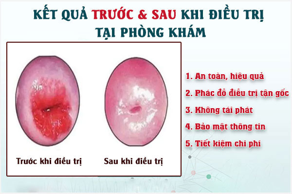 Dau-rat-vung-kin