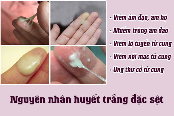 Huyet-trang-dac-set