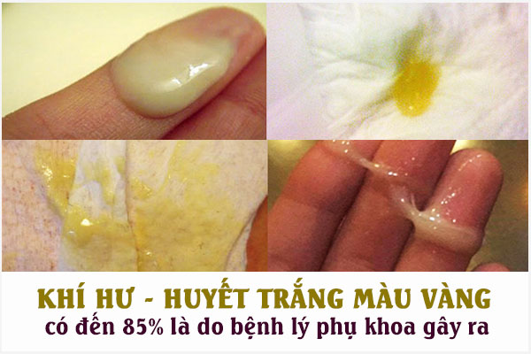 Huyet-trang-mau-vang