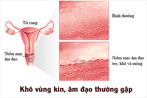Kho-vung-kin