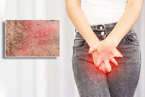 Nổi mụn ngứa vùng kín: Nguyên Nhân – Triệu Chứng – Cách Điều Trị