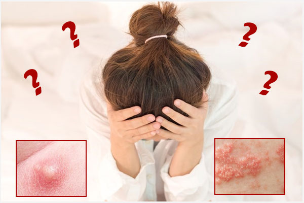 Nổi mụn ở háng/bẹn nữ giới là bị gì? Cách xử lý hiệu quả?