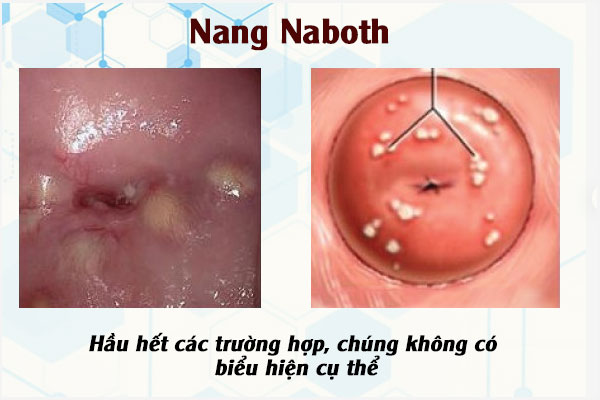 Mun-trong-tu-cung-2