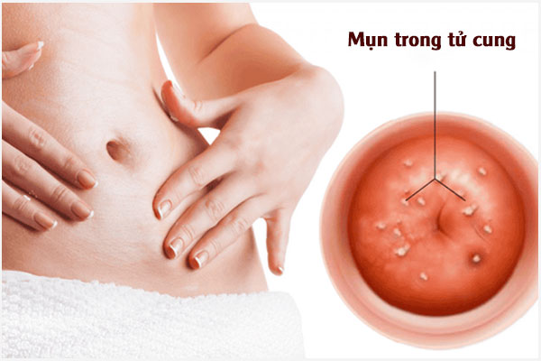Nổi mụn tử cung “âm thầm” nhưng nguy hiểm chị em không nên bỏ qua