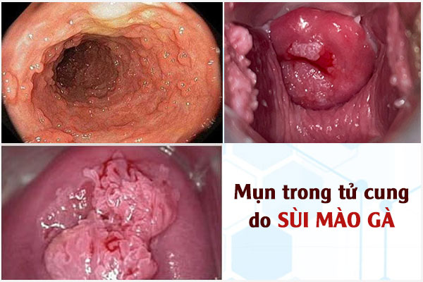Mun-trong-tu-cung