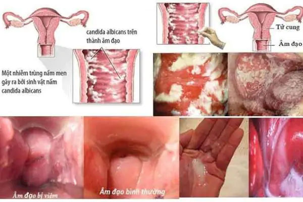 Nam-candida