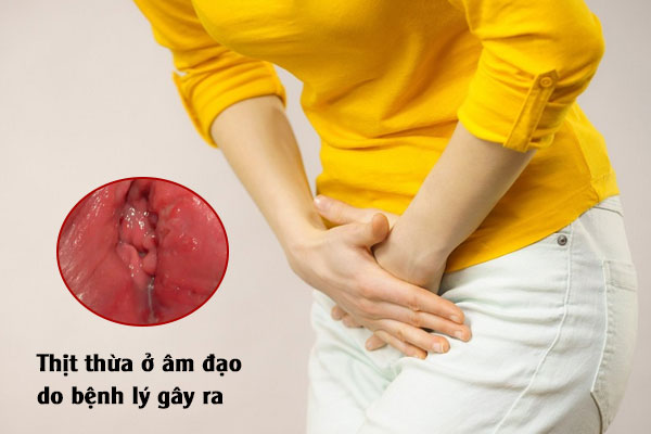 Thịt thừa âm đạo, vùng kín nữ: Bệnh gì và Cách điều trị?
