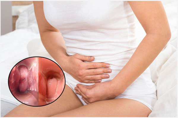 Thịt thừa vùng kín: Nguyên nhân và Cách xử lý an toàn