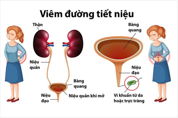 Triệu chứng và Nguyên nhân viêm đường tiết niệu nữ
