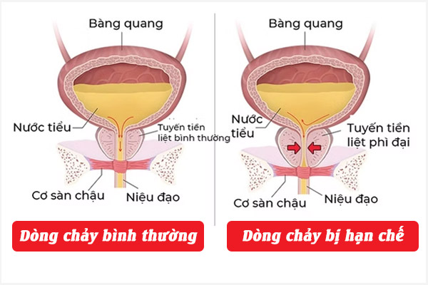 Bi-tieu-nu-1