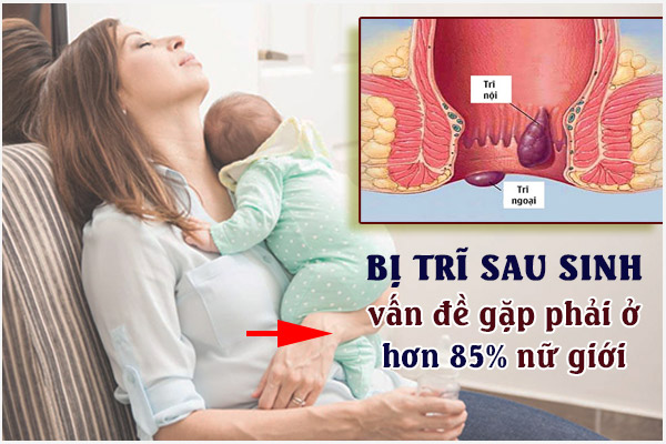 Bi-tri-sau-sinh