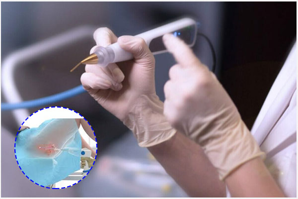 Đốt viêm lộ tuyến cổ tử cung có an toàn không? Đốt bằng cách nào hiệu quả?