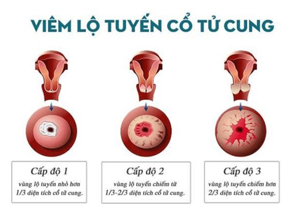 Dot-viem-lo-tuyen-1