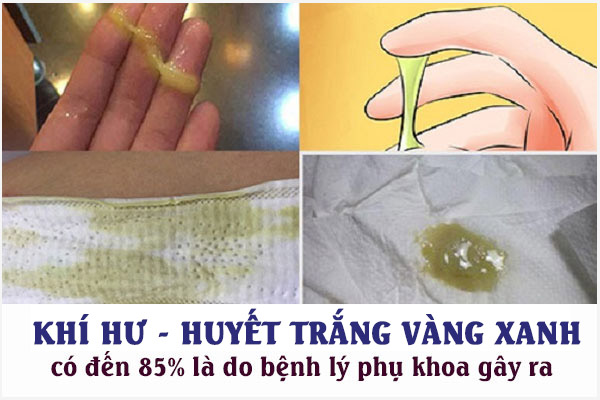 Ra khí hư màu vàng xanh có sao không? Cách khắc phục hiệu quả?
