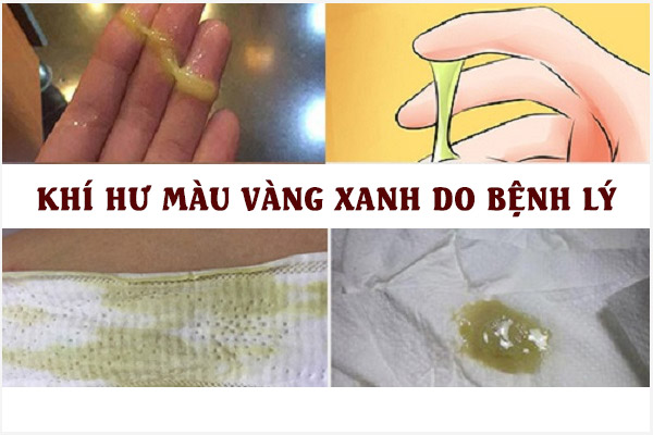 Vùng kín ra dịch màu vàng xanh nhiều là bị gì? Có nguy hiểm không?