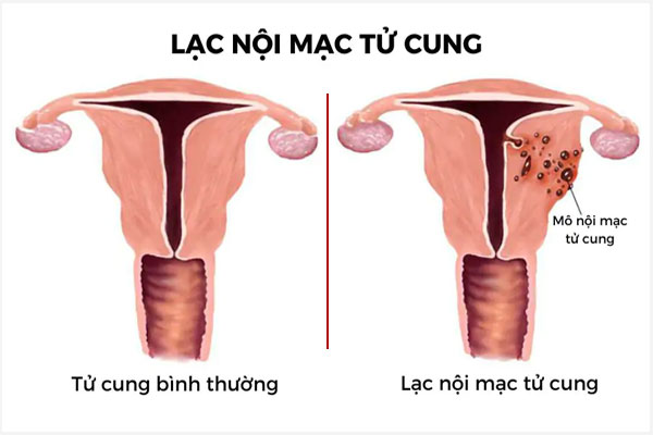 Lạc nội mạc cổ tử cung: Dấu hiệu, Nguy hiểm và Cách khắc phục hiệu quả tình trạng