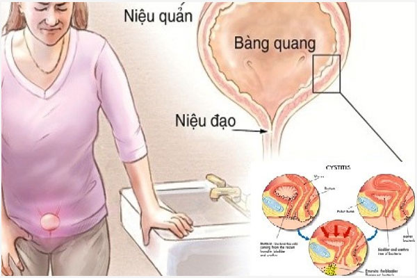 Nguyên nhân đi tiểu đau rát ở nữ giới và Cách khắc phục hiệu quả