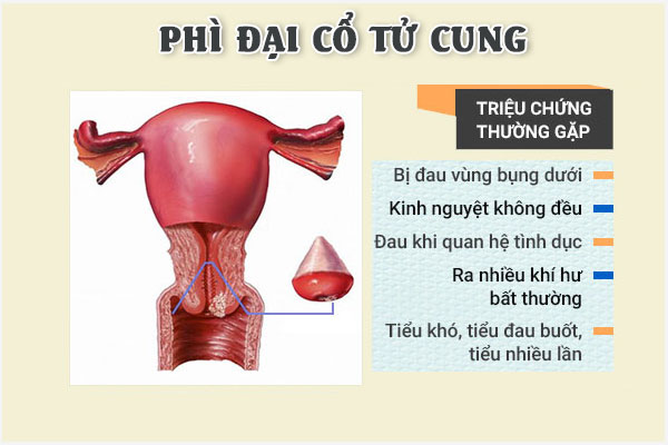 Phi-dai-co-tu-cung