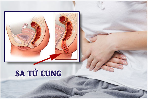 Sa cổ tử cung là gì? Có nguy hiểm không?