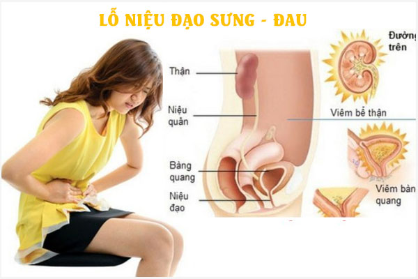 Sưng lỗ tiểu ở nữ: Nguyên nhân và Cách khắc phục hiệu quả