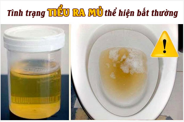 Tiểu ra mủ ở nữ giới có sao không? Là dấu hiệu của bệnh gì?