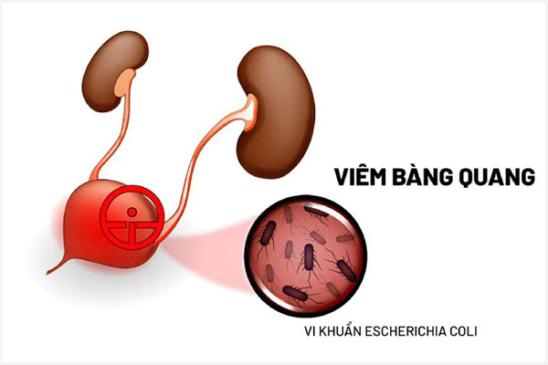 Viêm bàng quang nữ có sao không? Cách khắc phục hiệu quả