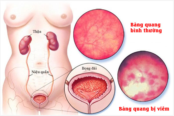 Viem-bang-quang