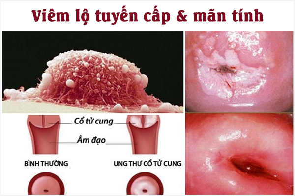 Viem-lo-tuyen-cap-va-man-tinh