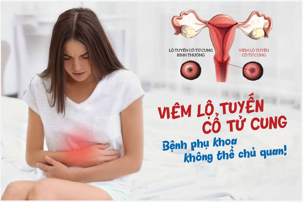 Cấp độ viêm lộ tuyến cổ tử cung: Triệu chứng và Cách chữa hiệu quả