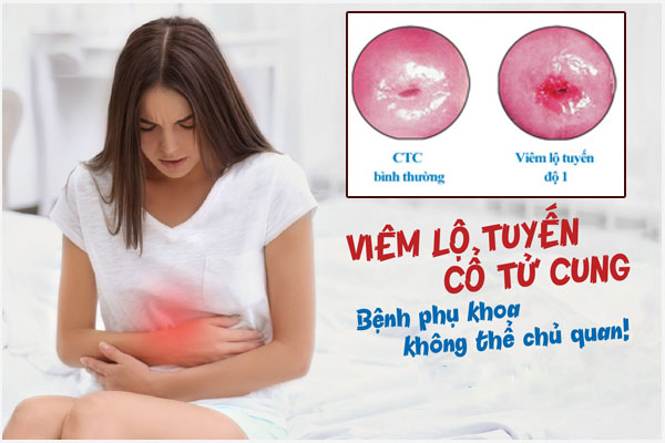 Nhận biết viêm lộ tuyến cổ tử cung cấp độ 1 và Cách khắc phục hiệu quả
