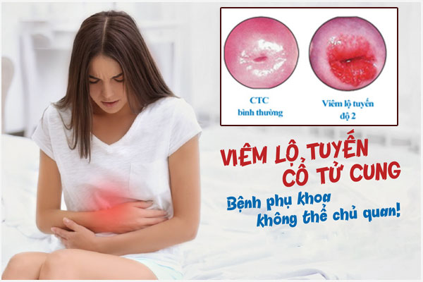 Nhận biết viêm lộ tuyến cổ tử cung cấp độ 2 và Cách khắc phục hiệu quả
