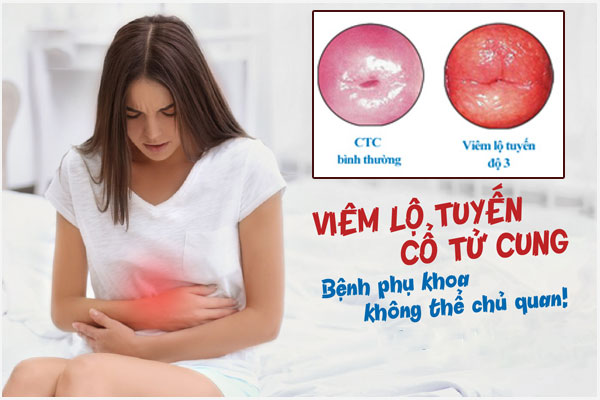 Cách điều trị viêm lộ tuyến cổ tử cung hiệu quả nhanh, ít tốn kém
