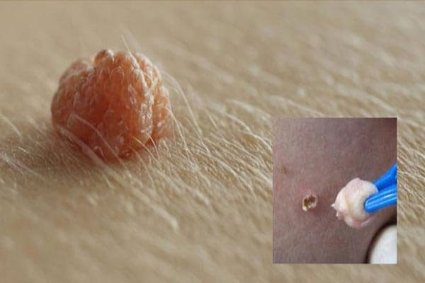 Nổi mụn cứng ở vùng kín nữ: Nguyên nhân, Cách khắc phục hiệu quả